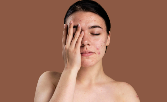 Nổi mụn do nóng trong, dấu hiệu nào bạn nên biết? 