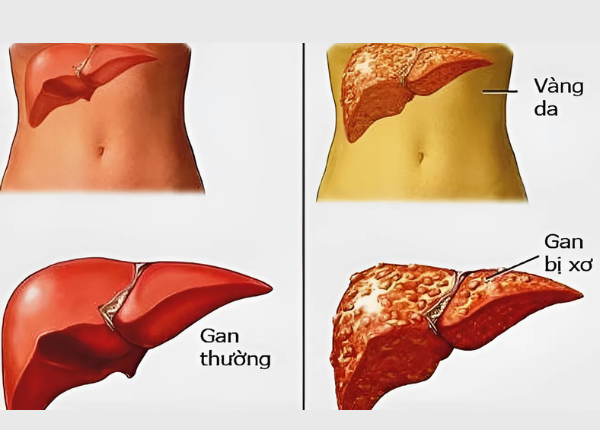 Xơ gan do rượu có chữa khỏi hoàn toàn được không?