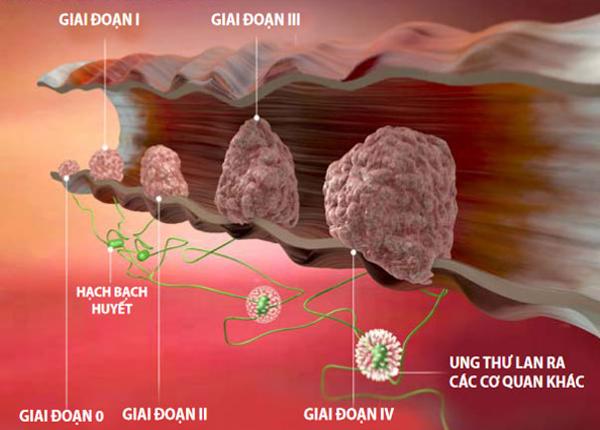 Mối liên quan giữa Polyp và ung thư đại trực tràng?