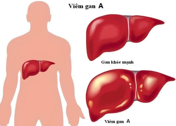FTT_Vien_gan_A_Nguyen_nhan_trieu_chung_va_phong_ngua_hieu_qua