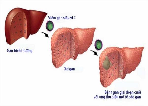FTT-Dau-hieu-xo-gan-do-mac-vien-gan-C va-cach-nhan-biet-1