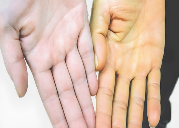 FTT-Viem-gan-C-co-tu-khoi-khong-dau-hieu-va-trieu-chung-nhan-biet-1