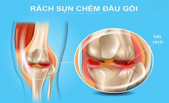 Vấn đề thường gặp khớp gối là gì?