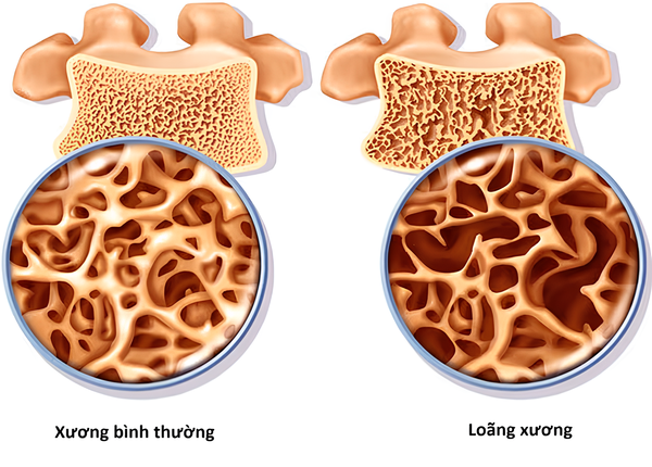 Độ tuổi bị loãng xương là bao nhiêu? Nguyên nhân do đâu?