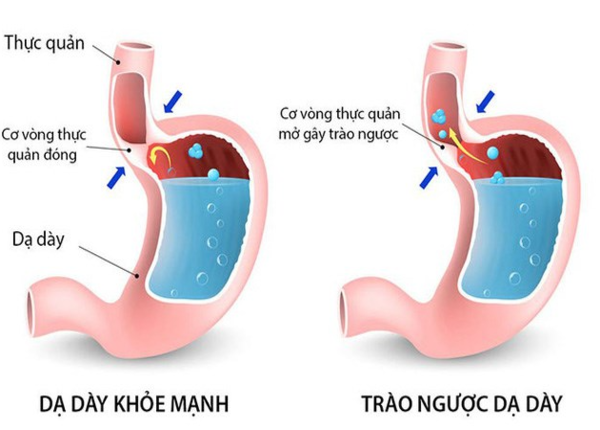 Nằm xuống ngay sau ăn dễ gây trào ngược dạ dày
