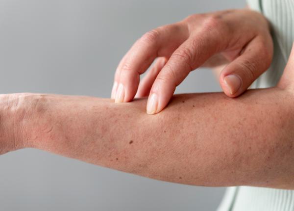 Phân biệt ngứa dị ứng và ngứa dưới da do bệnh gan