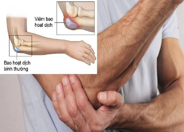 Viêm bao hoạt dịch là gì: Nguyên nhân và triệu chứng