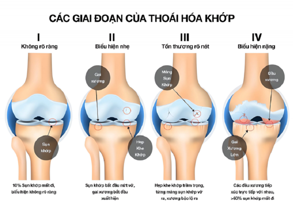 Gai xương phát triển hạn chế hoạt động của khớp và gây cứng khớp gối