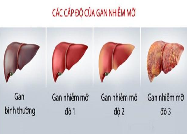 Gan nhiễm mỡ độ 1 là gì? nguyên nhân và cách nhận biết