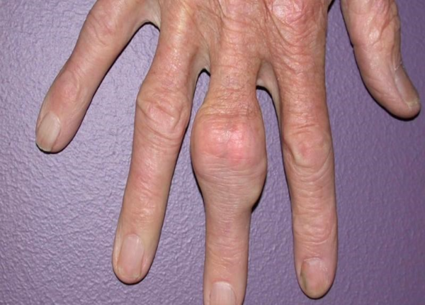 Hạt Tophi ở người bệnh gout: Sự nguy hiểm mà bạn cần biết?