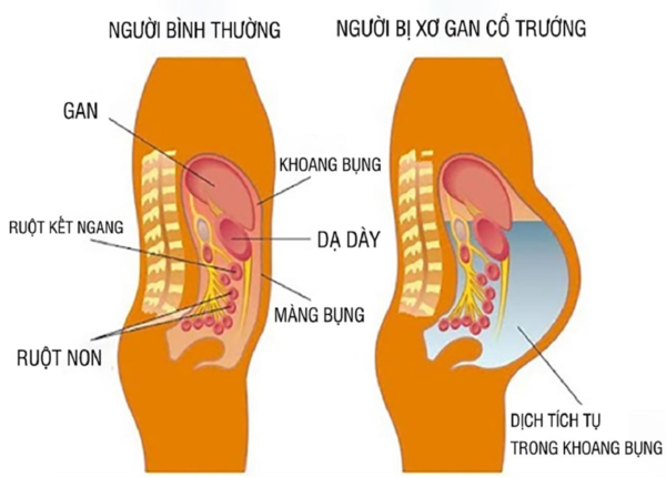 Xơ gan cổ trướng khiến gan bị xơ hóa nhanh, không còn độ mền như trước