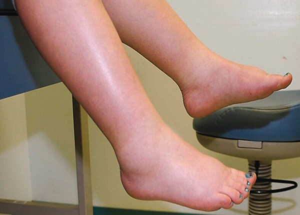 Ngiười bị xơ gan cổ trướng không chỉ bị tích nước bụng mà còn bị phù chân
