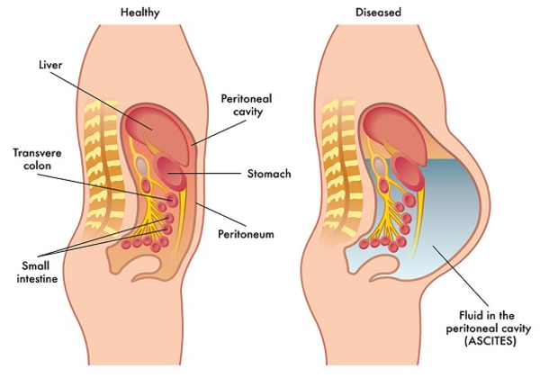 Xơ gan cổ trướng: Nguyên nhân và phương pháp điều trị
