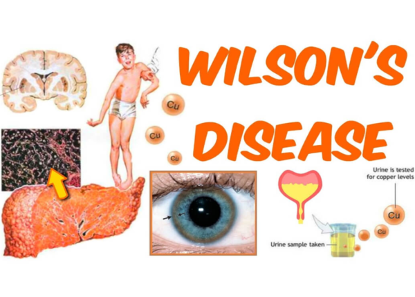 Bệnh Wilson là gì? Nguyên nhân, dấu hiệu và cách kiểm soát bệnh