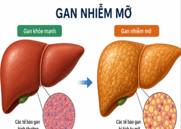 Gan nhiễm mỡ độ 2: Đặc điểm và phương pháp cải thiện