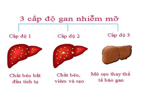 Gan nhiễm mỡ độ 2 kéo dài gây ra nhiều ảnh hưởng sức khỏe