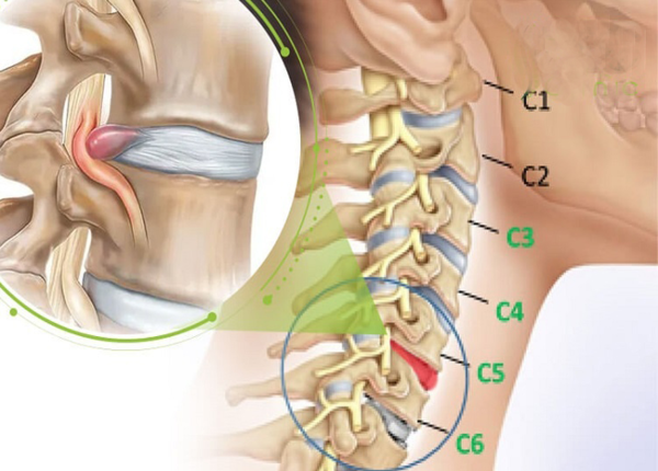 Thoát vị đĩa đệm cổ: Dấu hiệu, nguyên nhân nhận biết