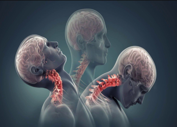 Thoái hóa đốt sống cổ là nguyên nhân gây cứng mỏi cổ kéo dài
