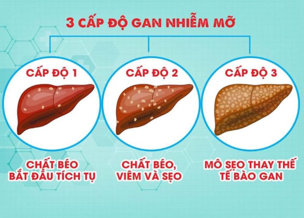 Gan nhiễm mỡ độ 1 có khỏi không?