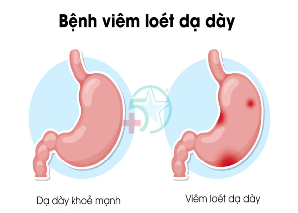 Tổn thương niêm mạc khiến máu chảy xuống dưới, chuyển màu phân thành đen