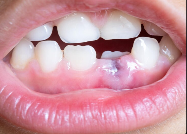 Sjogren gây khô miệng, giảm tiết nước bọt, dễ làm tụt lợi, hôi miệng người mắc