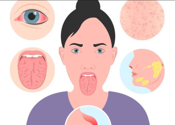 Hội chứng Sjogren là một bệnh lý xảy ra có liên quan đến hệ thống phòng vệ của cơ thể