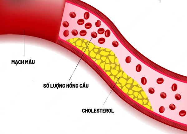 Rối loạn mỡ máu: Nguyên nhân, hệ quả đi kèm