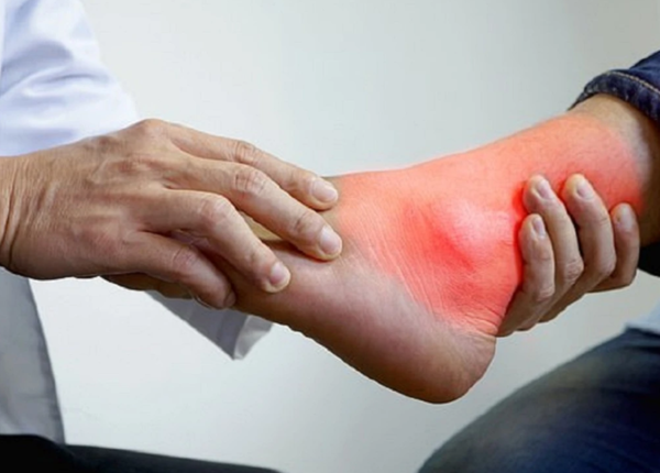 Sưng mắt cá chân: Phân biệt sưng do chấn thương hay phù chân