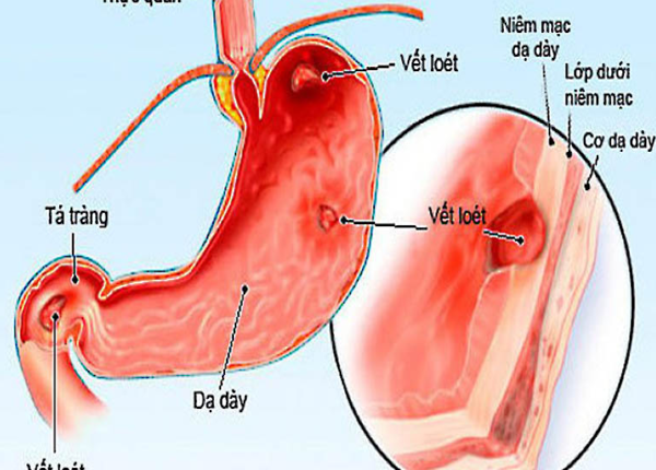 Viêm loét dạ dày cũng là một biến chứng nghiêm trọng nếu tình trạng trào ngược kéo dài liên tục